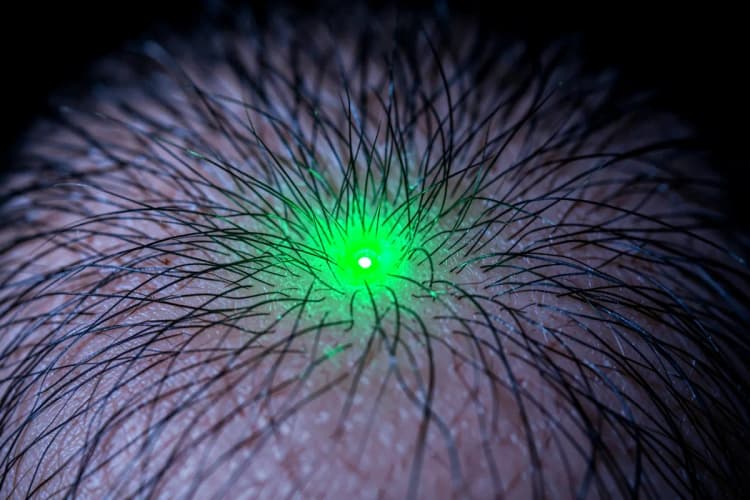 Couro cabeludo com folículos capilares visíveis, com um laser verde incidindo sobre um folículo.