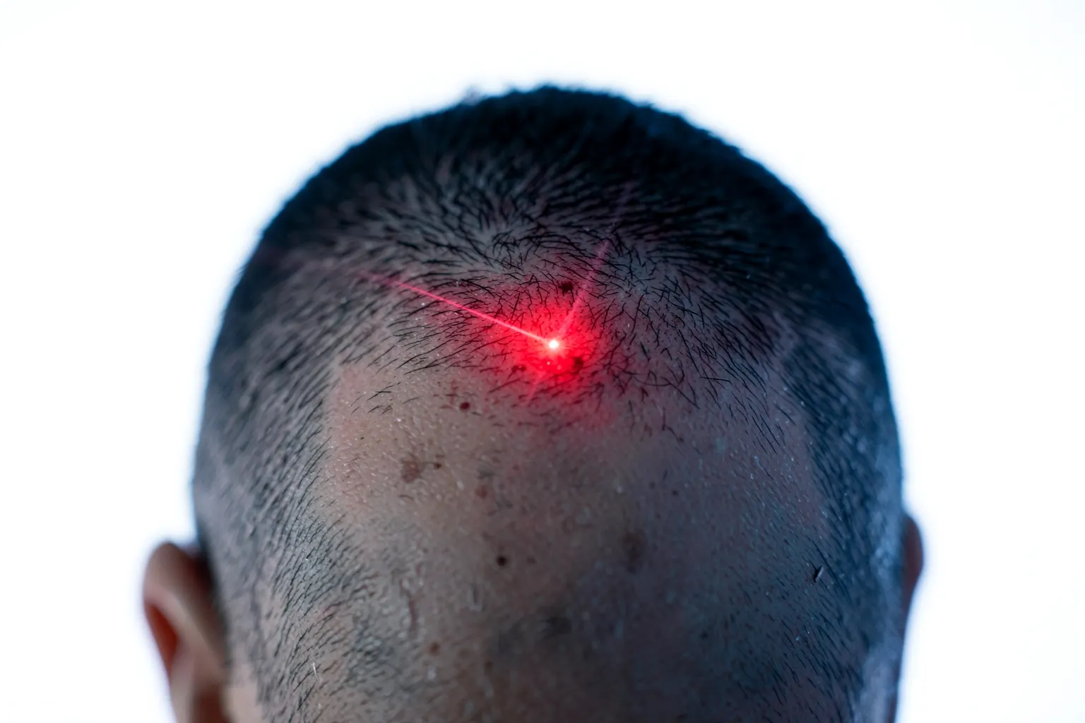 Benefícios do tratamento a laser em comparação com outras opções para queda de cabelo