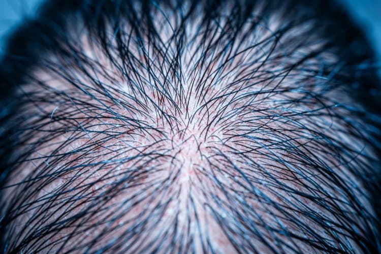 Um close-up de um couro cabeludo com folículos capilares visíveis, mostrando a saúde do cabelo.