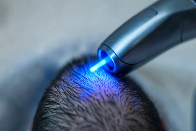 Um close-up de um dispositivo de laser capilar emitindo luz azul sobre um couro cabeludo.