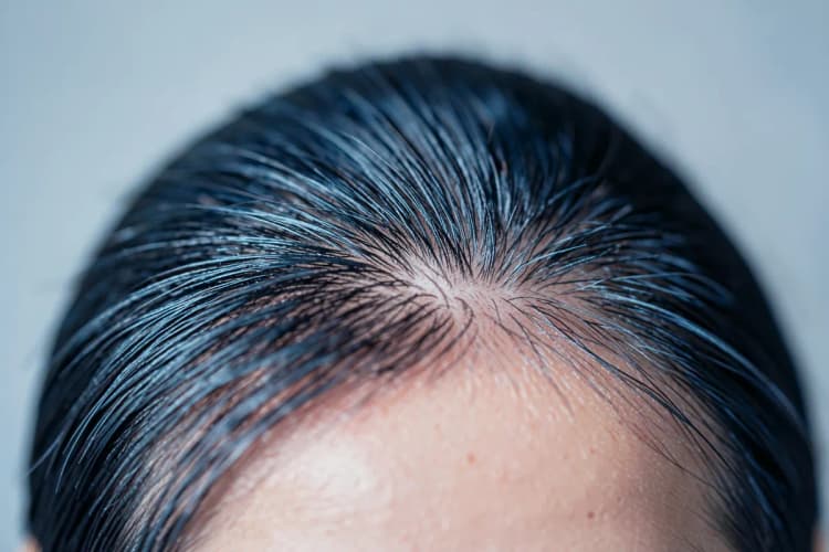 Um couro cabeludo limpo e saudável após o tratamento a laser, com cabelos com aparência revitalizada.