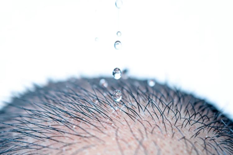 Gotas de líquido caindo sobre um couro cabeludo com poucos fios de cabelo, em fundo branco.