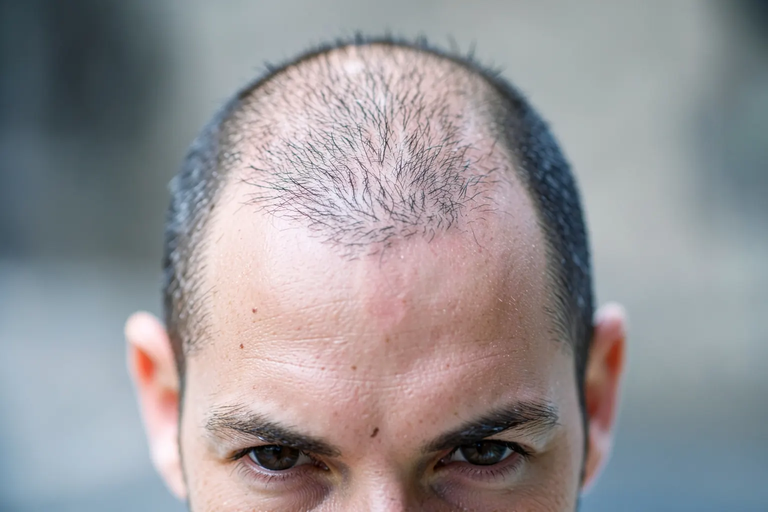 Homem com entradas pronunciadas no cabelo, olhando para o espelho com preocupação.